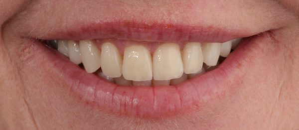 Tennur eftir meðferð með postulínsskeljum hjá Dentineo